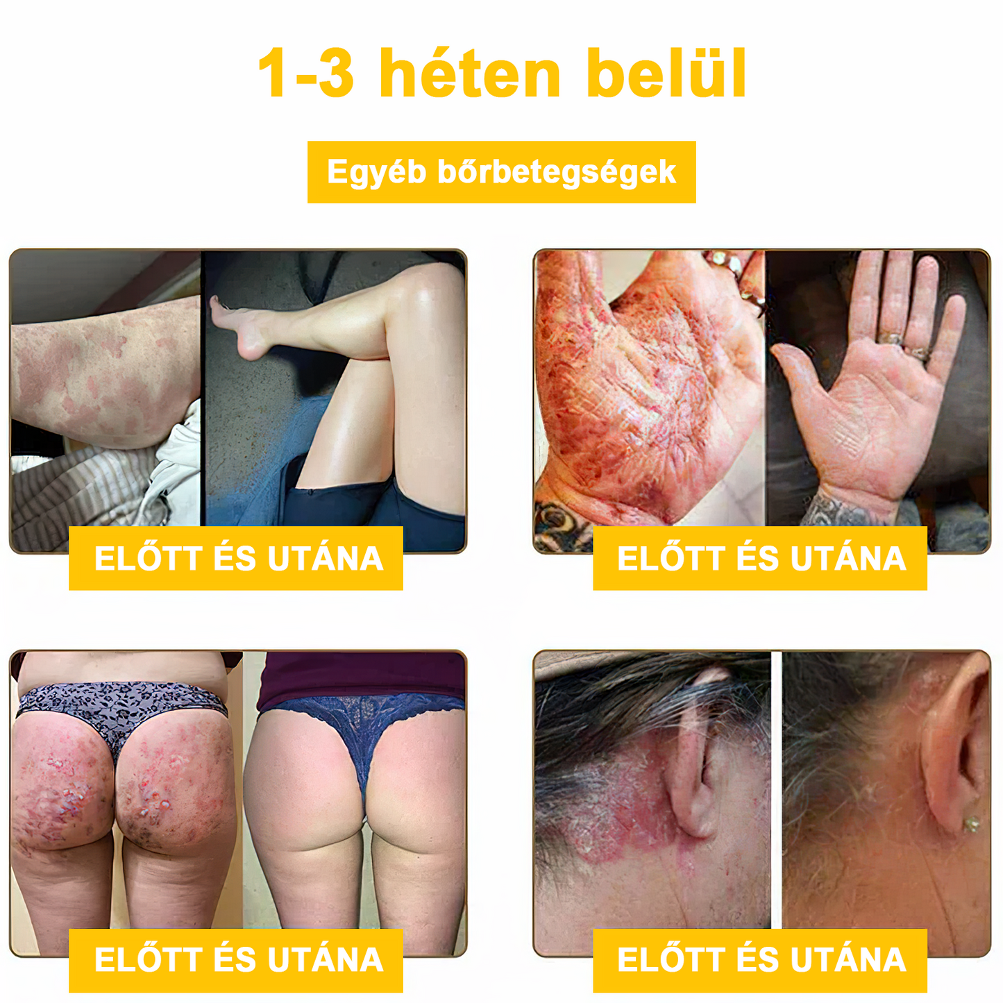 2024 ÚJ Velisse™ méhméreg bőrkrém（🧑‍⚕️AAD ajánlott), a szemölcsök, akné és hegek eltávolítására – többféle bőrbetegség kezelésére