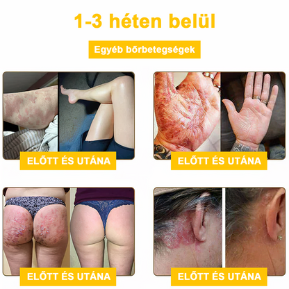 2024 ÚJ Velisse™ méhméreg bőrkrém（🧑‍⚕️AAD ajánlott), a szemölcsök, akné és hegek eltávolítására – többféle bőrbetegség kezelésére