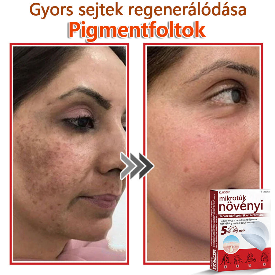 ✅KUBOZN® Mikrotűs Botanikus Bőrkinövés Eltávolító Tapaszok | Magyarországon készült