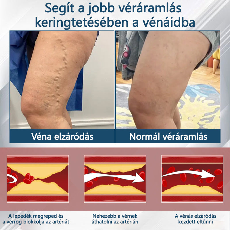 ✅✅ODEIUN® Fekete kömény Ödéma méregtelenítő gyógynövénykrém