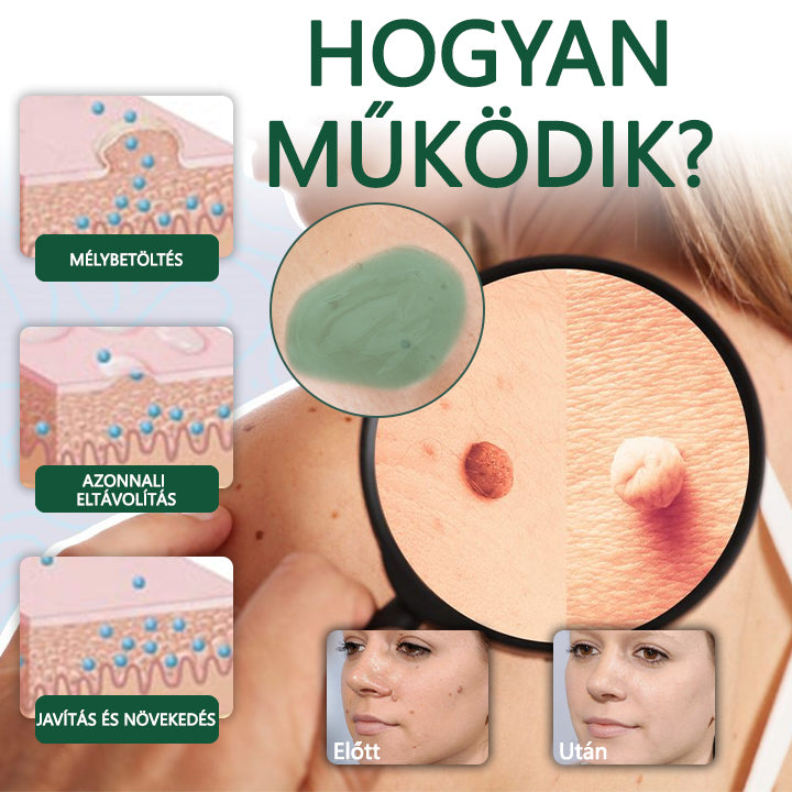 ✅✅Ceoerty® DermaErase azonnali anyajegy- és folteltávolító gél