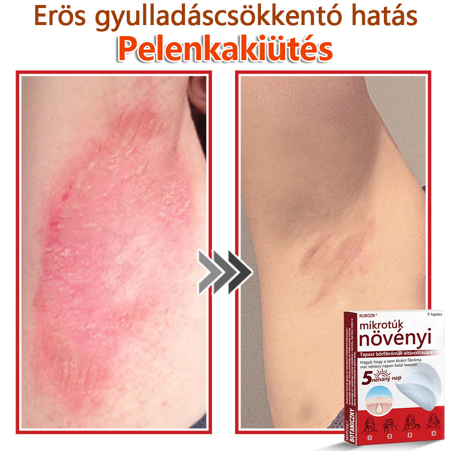 ✅KUBOZN® Mikrotűs Botanikus Bőrkinövés Eltávolító Tapaszok | Magyarországon készült