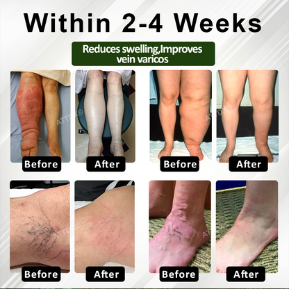 ATTDX® CircuHerb Edema Soothing & Healing Balm