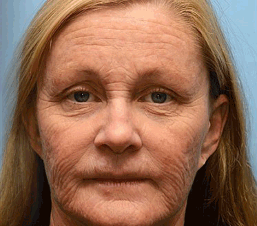 🍀Az akció utolsó napja: 83% kedvezmény✨𝐅𝐮𝐫𝐳𝐞𝐫𝐨™ Ránctalanító Krém Méhméreggel és Botox Hatással🐝